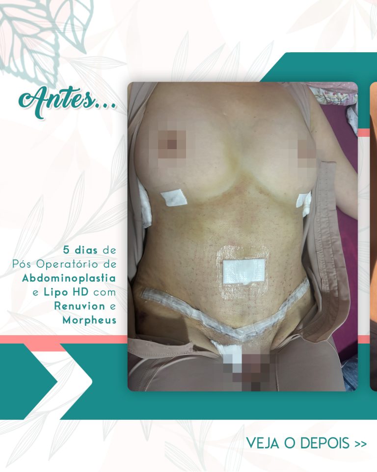 PRM—AntesXDepois_01